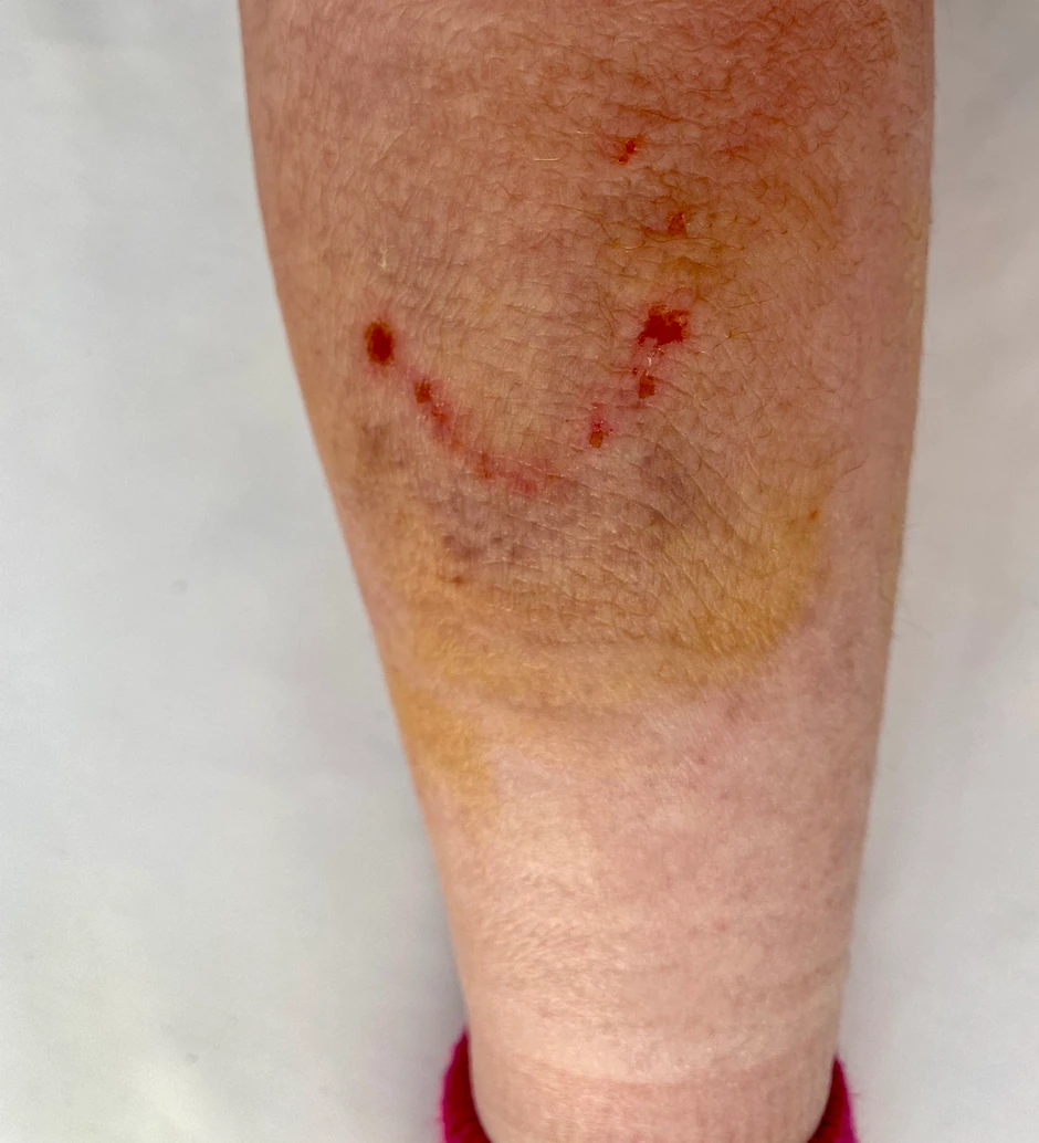 Noga devojcice koju je ujeo pas