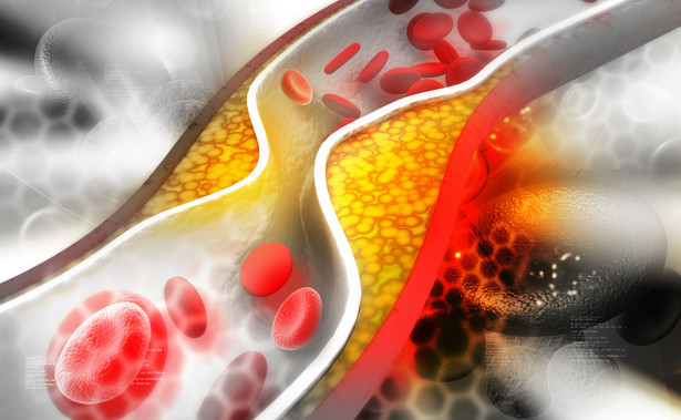 Co drugi Polak ma zbyt wysoki poziom cholesterolu, a leczy się niewielu