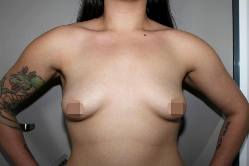 Australia: Przeszła operację powiększenia piersi. Teraz płacze