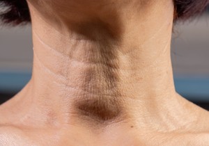 "Ćureći vrat" na koži je estetski termin za opuštenu kožu i nakupljene masnoće ispod brade i na vratu