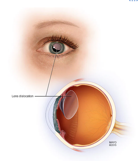 Dislokacija oka