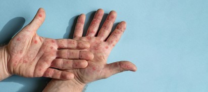 Majomhimlő: ennyivel nőtt a fertőzöttek száma Magyarországon