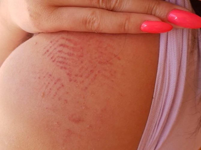 Povrede koje je zadobila Piroćanka koja tvrdi da ju je pretuklo pet devojaka