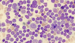 Krvna slika hronične limfocitne leukemije (HLL), analizirana mikroskopom, originalno uvećanje 1000x