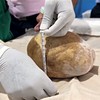 Lekari uspešno su uklonili kamen iz bešike težak 3,1 kg, što je najteži poznati slučaj u medicinskoj istoriji