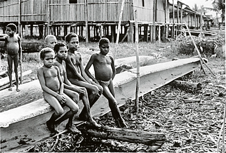 Mnoge žrtve pate od nekontrolisanih napada smeha - i umiru manje od godinu dana nakon što su prvi put pokazali simptome bolesti