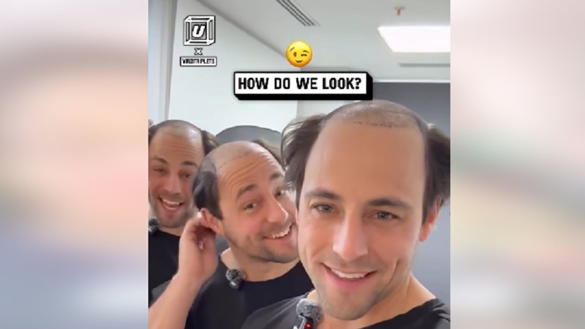 Braća, identične trojke, otišla na transplantaciju kose u Tursku i evo šta se desilo