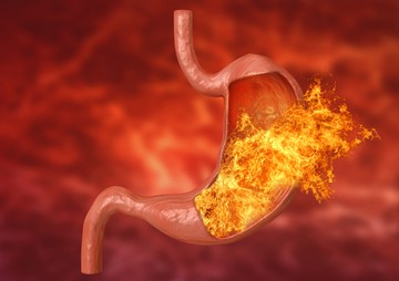 reflux, gyomorégés, GERD, gyomorsav, rekedtség, gyomorfájás, torokfájás, légszomj, gombócérzés