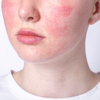 Piros erek az orron, érzékeny arcbőr: így lehet enyhíteni a rosacea tüneteit