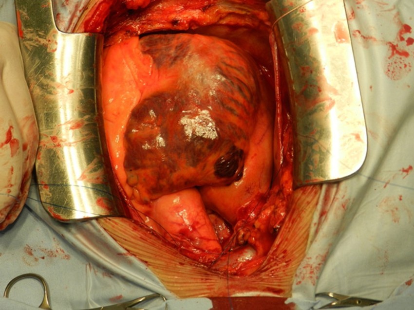 Hirurzi otvaraju grudni koš i dolaze do obolelog srca