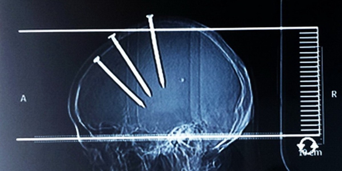 Mężczyzna miał 3 gwoździe w mózgu i przeżył