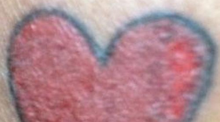 Gusztustalan fertőzés lett a tetoválás vége