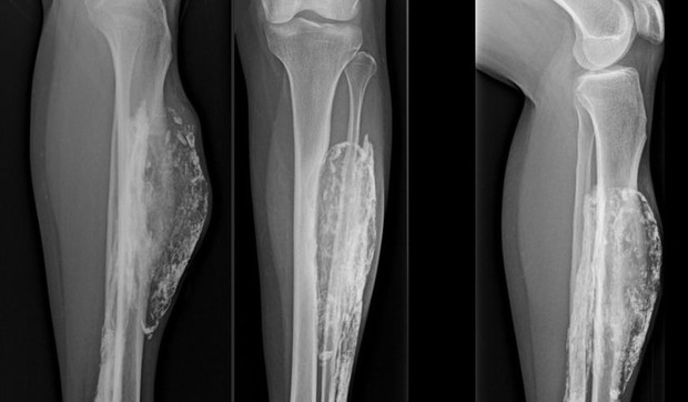 487782_tajland-zmija-noga-foto-journal-of-medical-case-reports