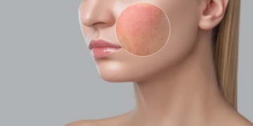 Szisztémás lupus erythematosus (SLE)