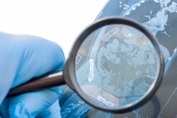 A fekélyes vastagbélgyulladás (colitis ulcerosa) a végbelet csaknem mindig érintő, a vastagbél-nyálkahártyát megbetegítő, véres hasmenéssel járó betegség. Pontos kiváltó oka mai napig ismeretlen, a legáltalánosabban elfogadott álláspont szerint hátterében az immunrendszer kóros működése áll.