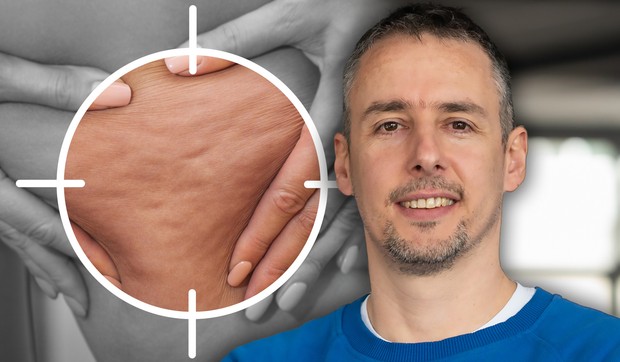 Celulit je kompleksan problem koji zahteva sistemski pristup