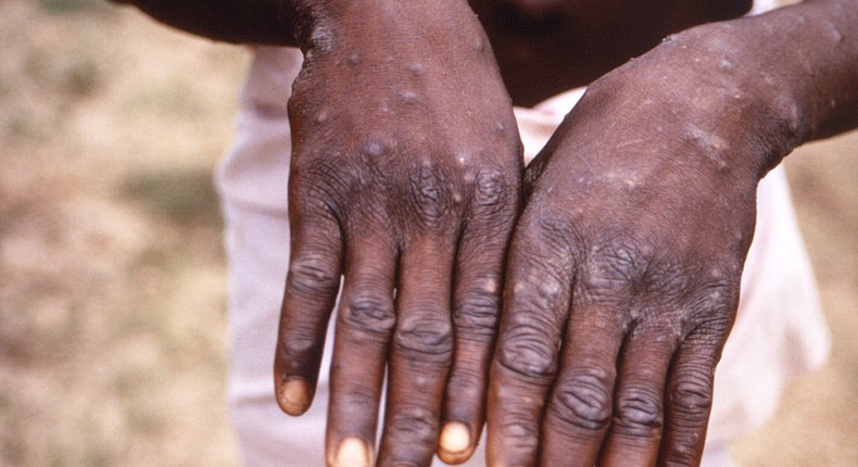 A person with monkeypox in the Democratic Republic of the Congo holds out their hands, which are covered in lesions.