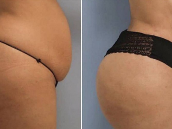Liposukcija 