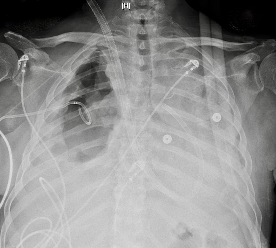 Snimak brajanovih pluća