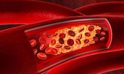 Jednoznaczne znaki, że to już najwyższy czas na badanie cholesterolu