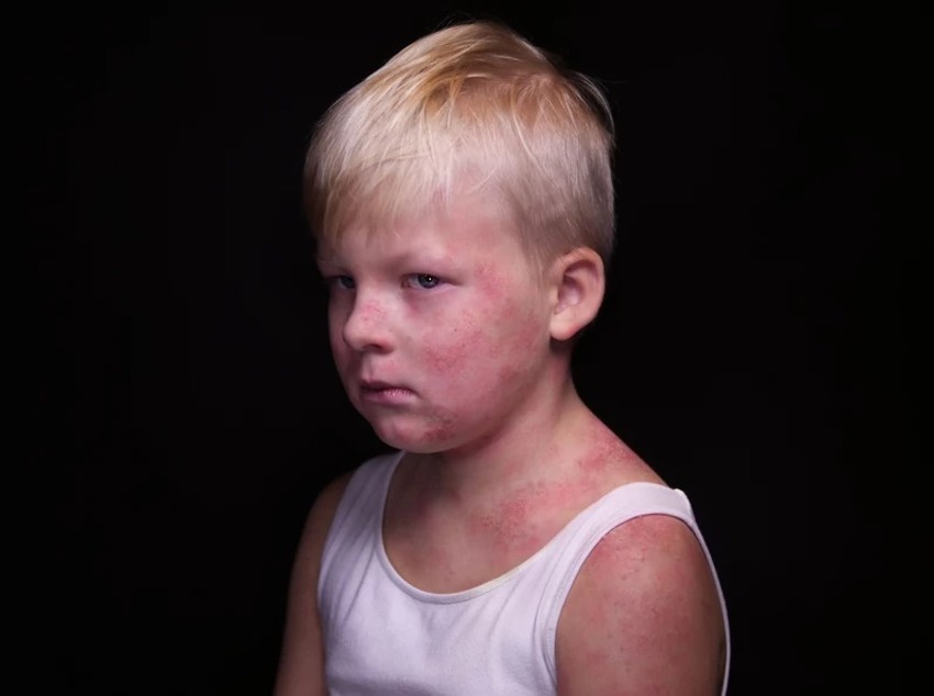 Bolesti koje su iskorenjene vakcinama