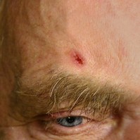 Nem gyógyuló fekély, seb - bőrrákot is jelezhet, ha így néz ki!