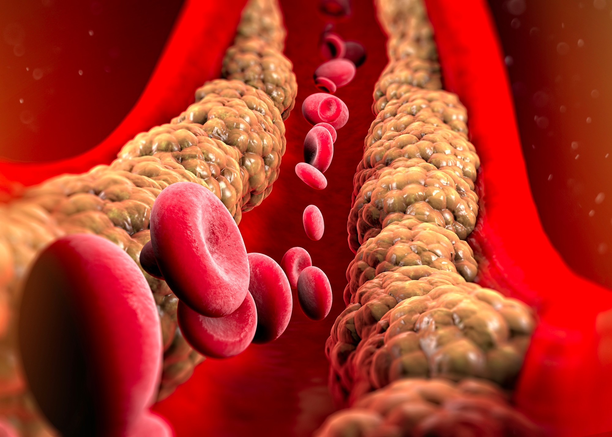 Cholesterol dokáže upchať vaše tepny.