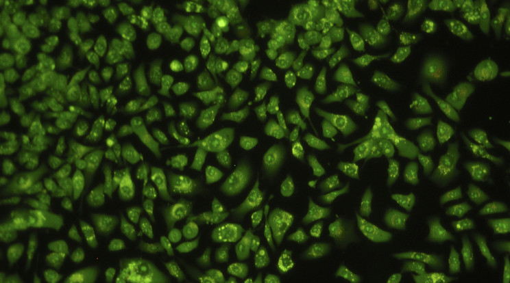 Emberi rákos sejtek a tüdőben mikroszkóp alatt / Illusztráció Northfoto