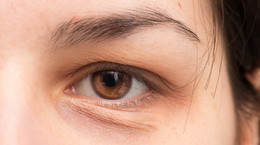 Podkrążone oczy - przyczyny i domowe sposoby