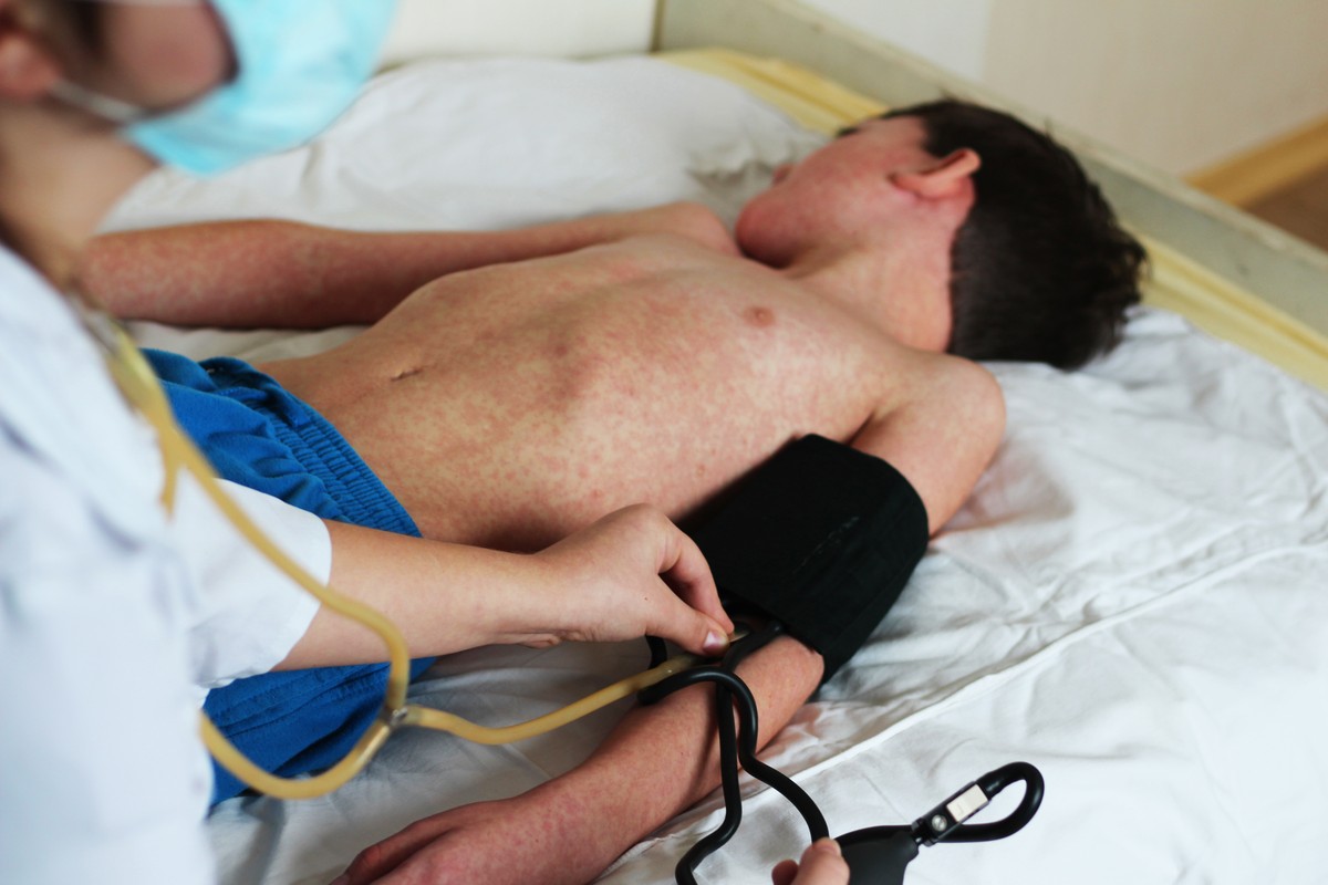 ECDC ostrzega przed epidemią odry. Kto jest najbardziej zagrożony?