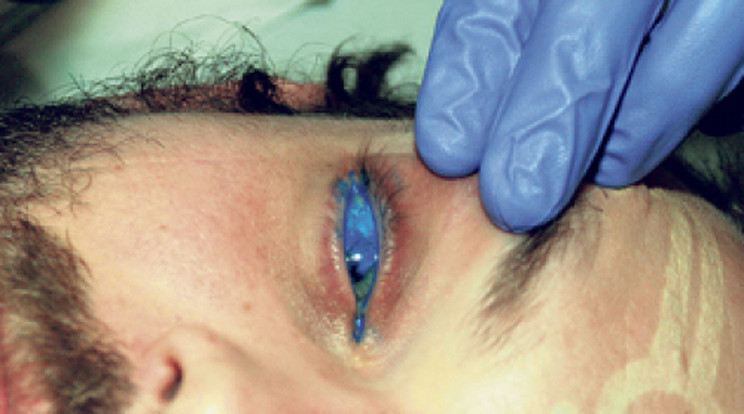 Veszélyes őrület a retina tetoválása 