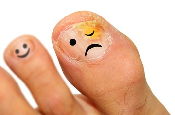 körömgomba, onychomycosis, otthoni gyógymód, lábköröm, sárga köröm