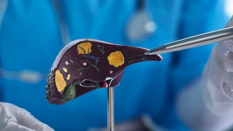 Steatóza pečene v slovenskej populácii narastá. (ilustračné foto)