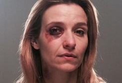 Joanna Koroniewska z podbitym okiem. Szokujące zdjęcie aktorki