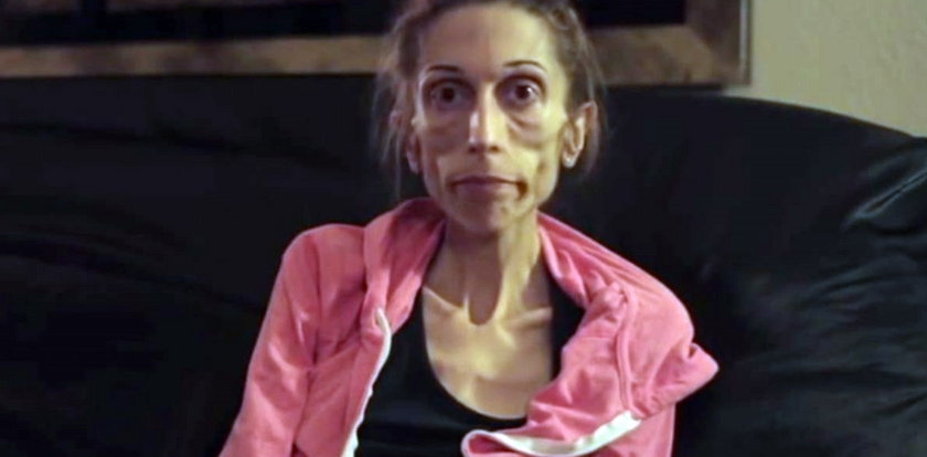 Ta aktorka walczy z anoreksją. Waży 20 kilogramów