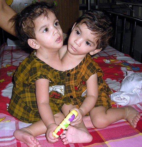 Bliźniaczki syjamskie - Aradhana i Stuti