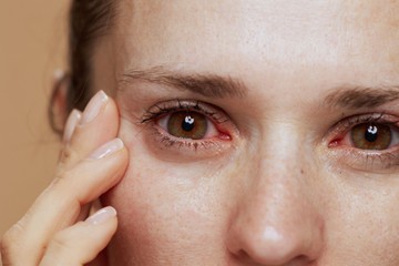 szemviszketés duzzadt szem gyulladás allergia pollen