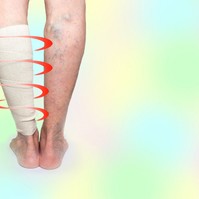 Vénafalgyulladás (tromboflebitisz): okai, tünetei, kezelése és megelőzése