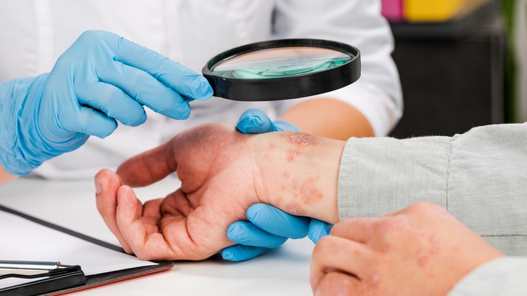 bőrszárazság, bőrviszketés, ekcéma, dermatitis, atópia, exogén ekcéma, endogén ekcéma, bakteriális felülfertőződés, allergiateszt
