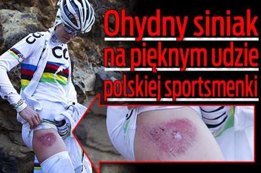 Ohydny siniak na udzie polskiej sportsmenki!