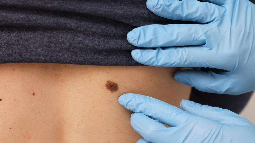 agresszív melanoma bőrrák tünete jele felismerése