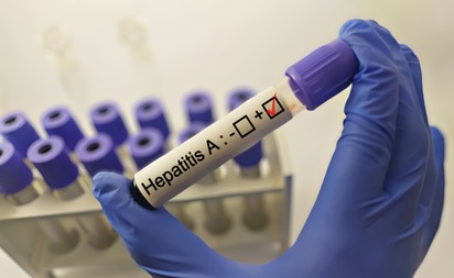 Hepatitisz A