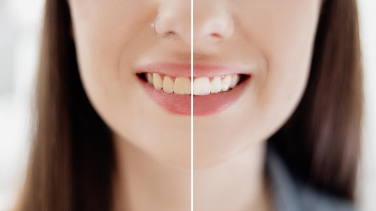 Ezzel a 3 természetes, házi módszerrel mondjon búcsút a sárguló fogaknak