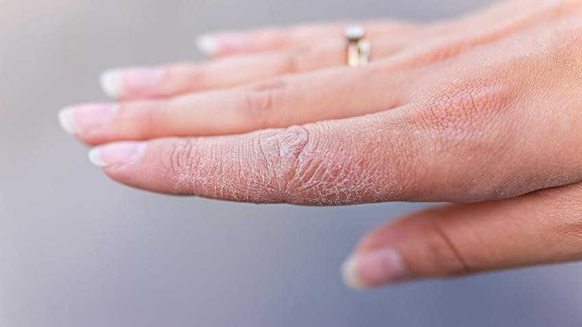 kézápolás bőrápolás pigment foltok fertőtlenítő hidratálás