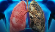 Rak płuc - typy, zachorowalność, czynniki ryzyka. Jak rozwija się rak płuc i jak go rozpoznać?