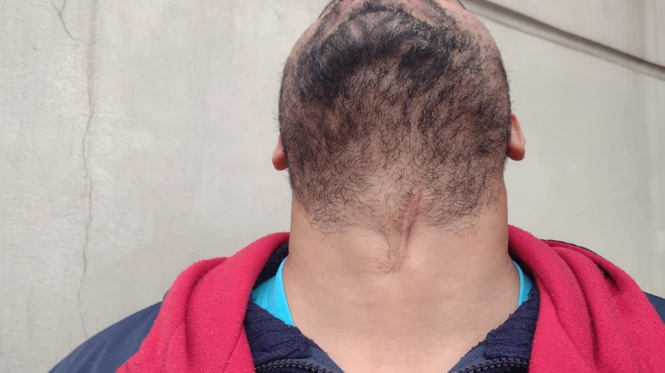 Srđan Stojković koji je uboden u vrat pokazuje ožiljak od rane 