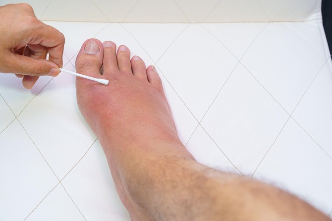 Primer evidentnog edema 