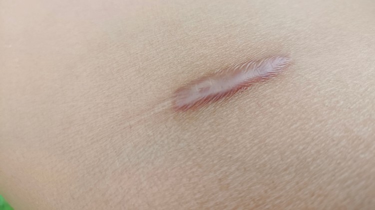 keloid jelentése