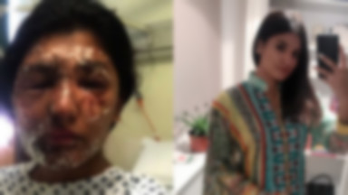 Ofiara ataku kwasem opublikowała nowe zdjęcia swoje twarzy