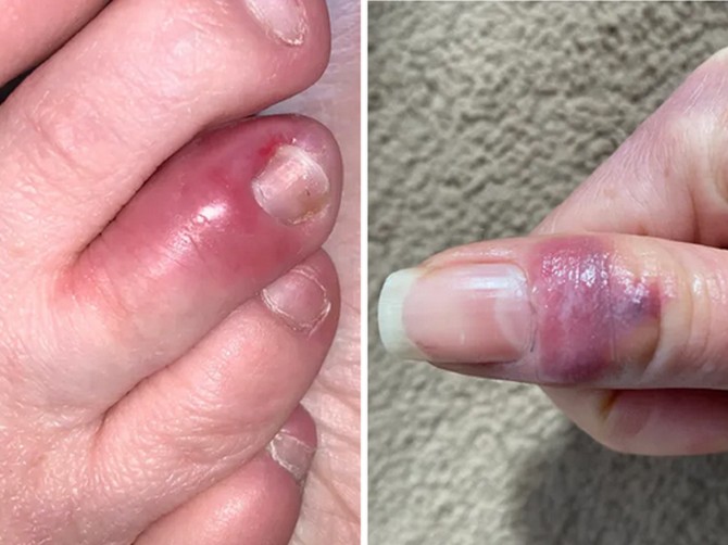 Kovid prsti: pacijenti otkrili kako izgledaju kožne promene, ustupljena fotografija: COVID Symptom Study 